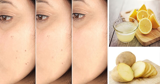 How To Get Rid of Dark Spots Naturally With Lemon and Potato Remedy